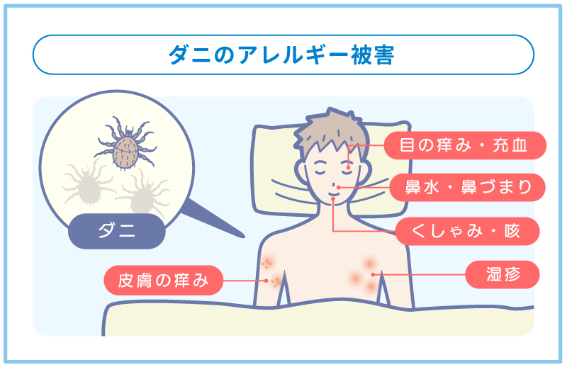 ダニのアレルギー症状